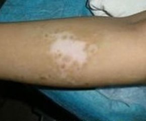 不同时期的白癜风有什么症状表现?(图1)