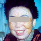 老年人患上白癜风为什么比较难治疗?(图1)