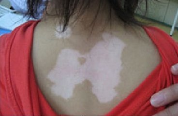 导致女性患上白癜风的原因有什么?(图1)