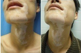 导致人们患发白斑的原因是什么?(图1)