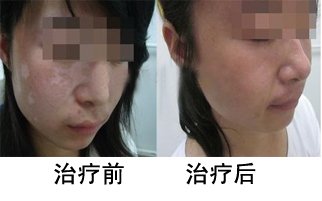 治疗白癜风有什么好办法?(图1)