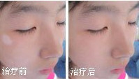 白癜风疾病会遗传吗?(图1)