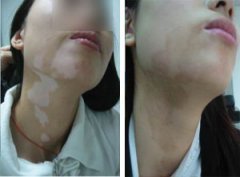 女性得了白癜风的症状是什么样的?(图1)