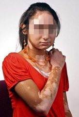 女性白癜风治疗后为什么会复发?(图1)