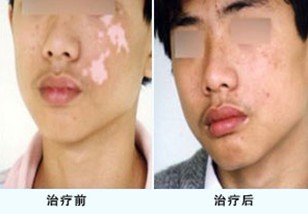 儿童治疗白癜风的措施有哪些?(图1)