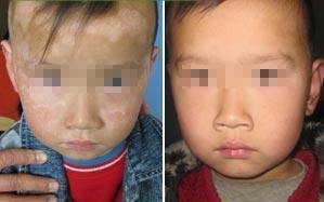 孩子身上的白斑有多大危害?(图1)