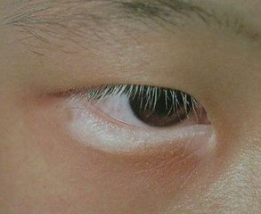 白斑病和白癜风有哪些不同?(图1)