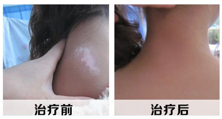 背部要是出现白癜风应该注意什么?(图1)