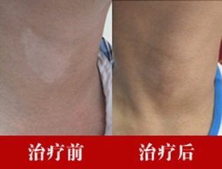 白癜风患者如何进行更好的治疗呢?(图1)