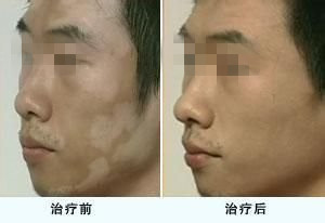 诊断白癜风的事项有哪些呢?(图1)