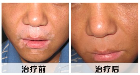 白癜风复发的因素有哪些?(图1)