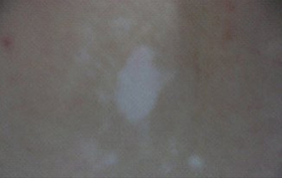 白癜风的发病原因有哪些呢?(图1)