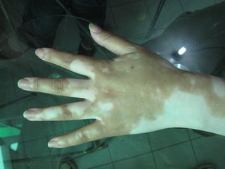 患有白癜风疾病的发病原因有哪些?(图1)