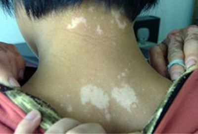 为什么白癜风难治疗呢?(图1)
