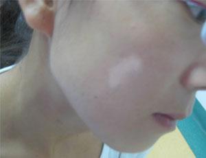 儿童出现白癜风的病因是哪些?(图1)