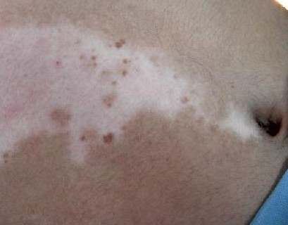 男性患上白癜风会遗传给孩子吗?(图1)