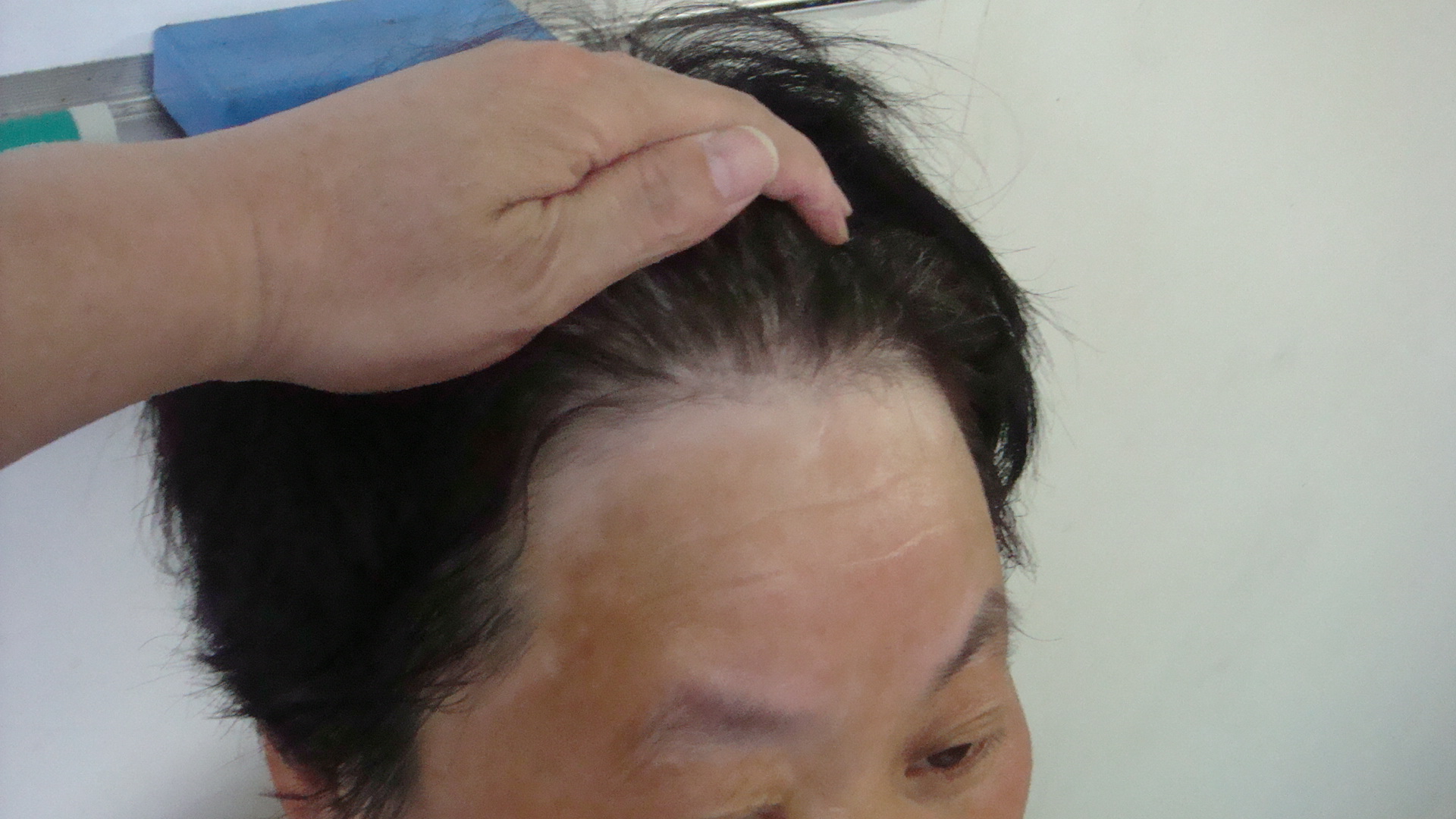 脸上的白癜风治疗费用贵吗(图1)