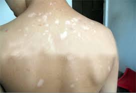 白癜风为什么会比较容易扩散?(图1) 白癜风为什么会比较容易扩散?(图1)