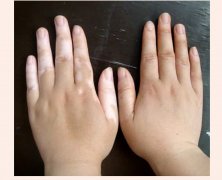 需要多长时间可以治好白癜风这种疾病?(图1) 需要多长时间可以治好白癜风这种疾病?(图1)